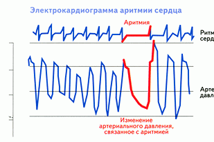 Аритмии и блокады сердца